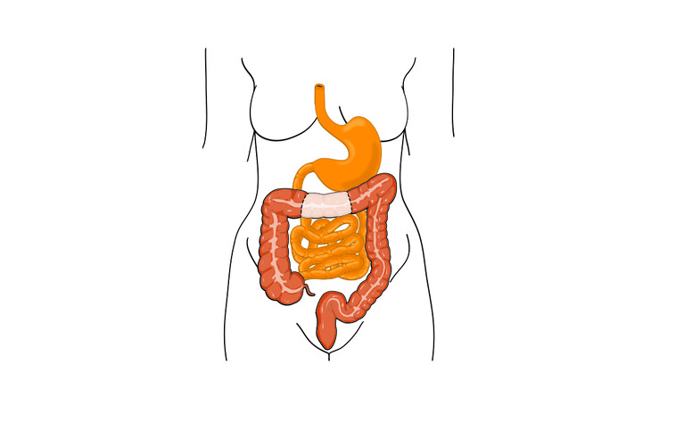 Colectomy resection for inflammatory bowel disease (IBD)