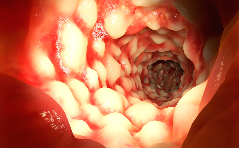 Crohn's disease viewed through an endoscope