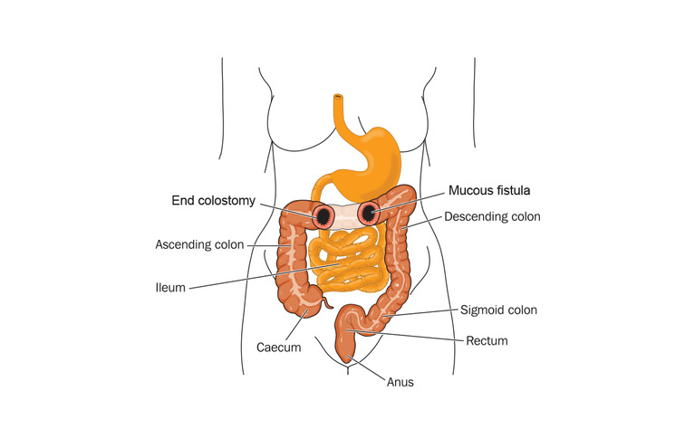 Colon with an end colostomy and mucous fistula