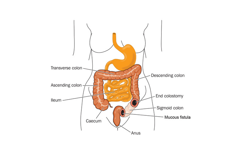 Colon with an end colostomy and mucous fistula