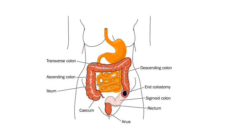 Colectomy with colostomy surgery for inflammatory bowel disease (IBD) - Crohn's disease and ulcerati
