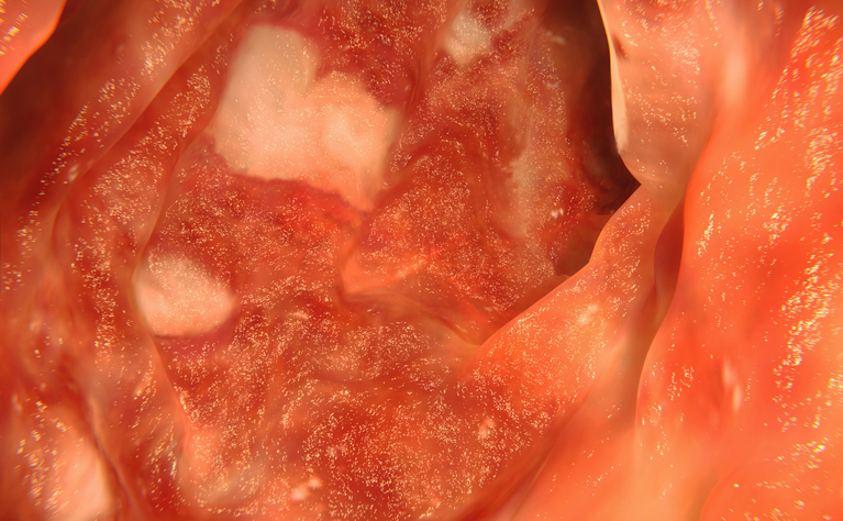 Ulcerative colitis endoscopy view of colon