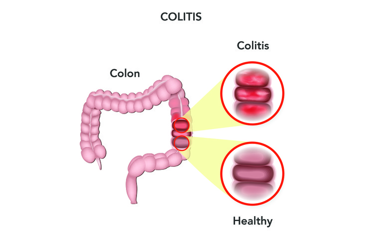Difference between healthy colon and colon with ulcerative colitis