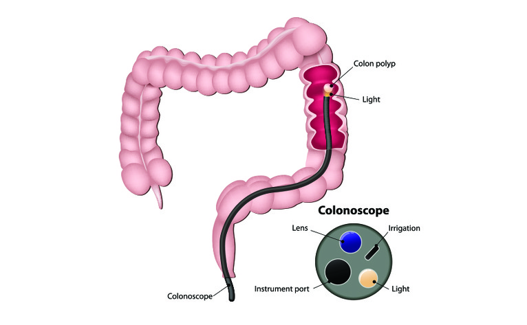 Colonoscopy for inflammatory bowel disease (IBD) - Crohn's disease and ulcerative colitis (UC)