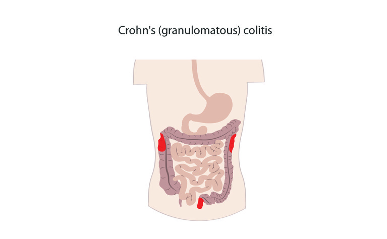 What is Crohnâ€™s (granulomatous) colitis?