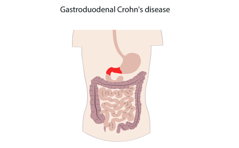 Gastroduodenal Crohns disease
