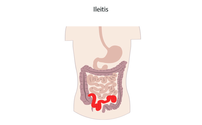 Crohn's ileitis