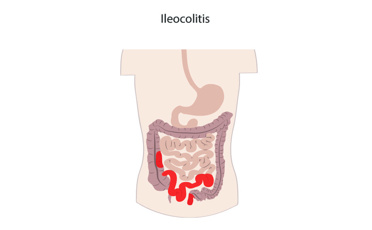 What is ileocolitis Crohn's disease?