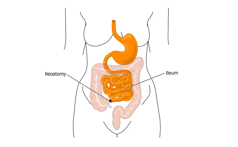 Ileostomy - inflammatory bowel disease (IBD) - Crohn's disease and ulcerative colitis (UC)