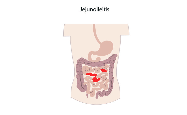 What is jejunoileitis Crohn's disease?