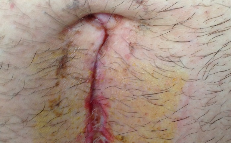Crohn's disease ileocaecal surgery scar