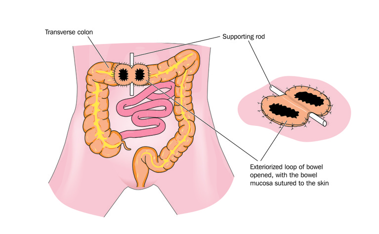 Stomas and inflammatory bowel disease  IBDrelief