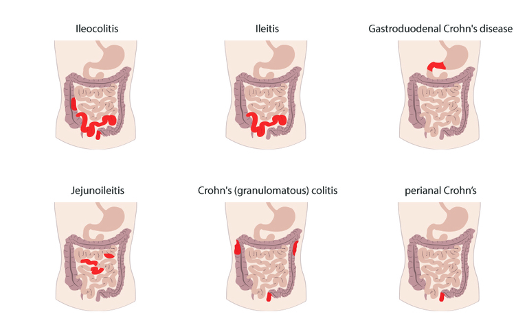 Types of Crohn's disease in children