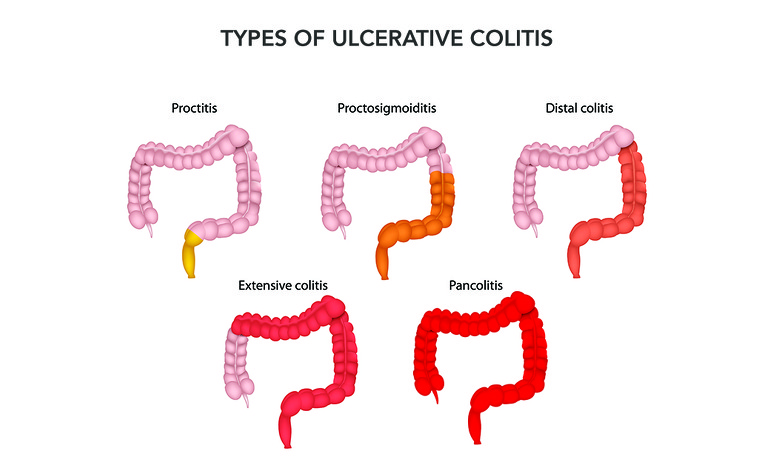 Types of ulcerative colitis - proctitis, proctosigmoiditis, distal colitis, extensive colitis, panco
