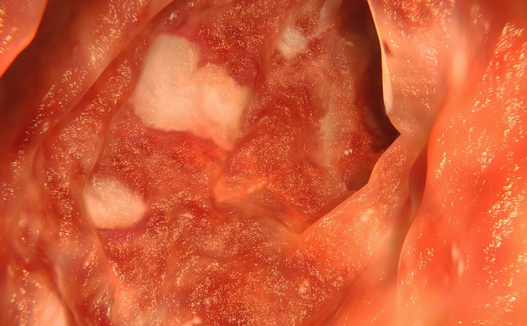 Internal image of colon with ulcerative colitis